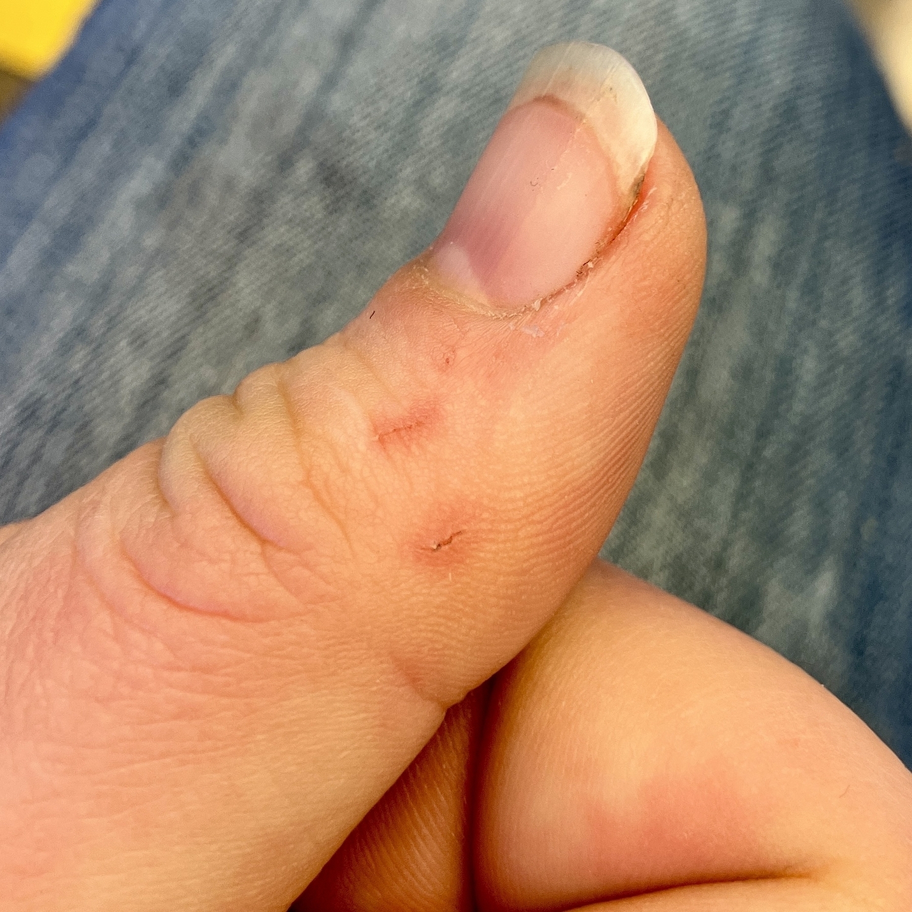 A close up of a white person's left thumb. There are two short, fresh scratches, with raised red edges, on the side. End ID.